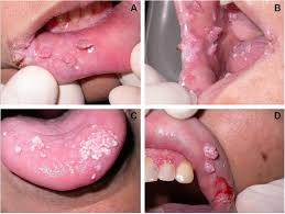 Image result for papillomavirus tongue)