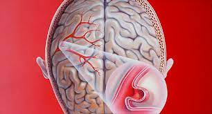 O aneurisma cerebral é uma saliência em forma de balão que surge em uma ou mais artérias cerebrais por conta de um enfraquecimento da parede do vaso. Bio Impressao 3d Para O Estudo Do Aneurisma Cerebral Portal Ifsc