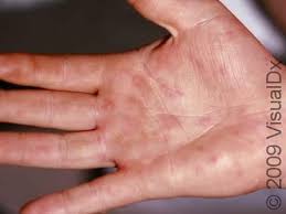 Image result for Papular urticaria