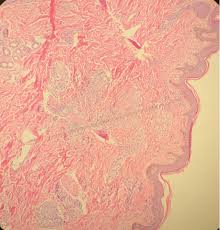 After some conversations and research i now know sarcoidosis can be mistaken for cancer. A Case Of Sarcoidosis With Pulmonary And Extrapulmonary Manifestations Consultant360