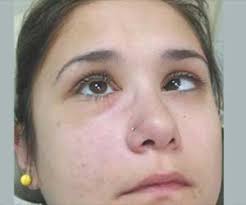 The chance is not affected by luck. Mucormycosis Black Fungal Disease A Complication Of Covid 19