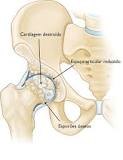 Artroplastia total de quadril (Total Hip Replacement ...