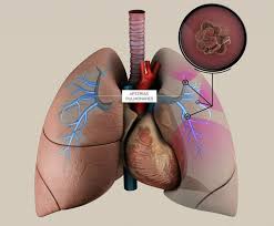 Pulmonary embolism (pe) is a blockage of an artery in the lungs by a substance that has moved from elsewhere in the body through the bloodstream (). Toda La Informacion Sobre La Embolia Pulmonar Trombo Info