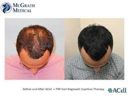 Ensure that if you do decide to receive stem cell therapy that. Acell Prp Hair Regrowth Injection Therapy Austin Houston Dallas Texas