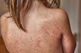 Image result for measles