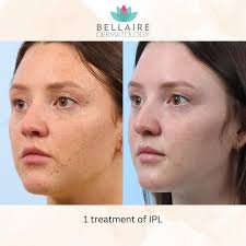 Bye, bye freckles and sun damaged skin👋 Our patient was recommended 3  treatments of IPL laser. Check out her results after just one treatment!!  She is very happy 🤭 p.s. friendly reminder