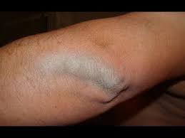 Petroleum jelly, a common item in nearly every medicine cabinet, is. How To Get Rid Of Dry And Scaly Elbows Youtube