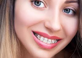 There are certain foods and candies that should not be eaten after braces have been placed on the teeth. Uncategorized