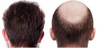 زراعة الشعر