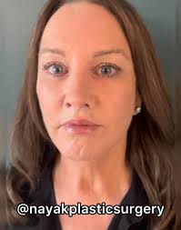 Mujer de 66 años perdió 50 kilos, dijo que su rostro "se derritió" y se  sometió a una cirugía — Los usuarios no podían creer que fuera la misma  persona