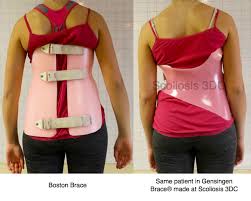 Braces can help a lot if you wear one when you have a serious injury. Which Scoliosis Brace Is Best Scoliosis Scoliosis Brace Braces