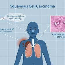 The tumors associated with this type of cancer are also typically large. Squamous Cell Carcinoma Of The Lungs Symptoms And Treatment