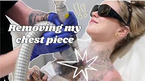 I got laser hair removal...everywhere *shocking results*