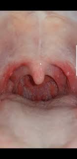 Bei einer chronischen angina (tonsillitis chronica) treten leichte schluckbeschwerden auf. Rachenentzundung Viral Oder Bakteriell Bild Gesundheit Und Medizin Schmerzen Viren