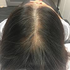 Apply directly to your scalp and then use. Scalp Micropigmentation For Women Smp Australia