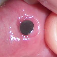 In this stage, neutrophils, which are a type of white blood cell, enter the wound area, and start cleaning it out. Healing A Lip Piercing Elayne Angel S Piercing Bible