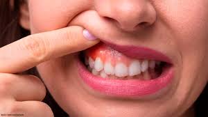 Image result for gums cancer symptoms