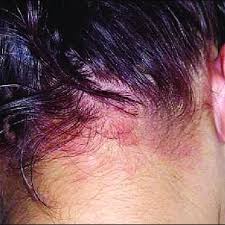 Your immune system forms antigens and tries to fight the foreign substance. Pdf Sensitisation From Ppd In Tempo Rary Henna Tattoos And Subse Quent Severe Allergic Contact Dermatitis From Hair Dye