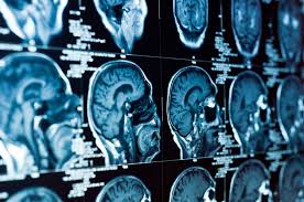 Find out what a cat scan is, what cat scan stands for, and what a cat scan shows. How Is A Stroke Diagnosed And Treated Agingcare Com