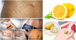 4 Bienfaits Du Citron Pour Les Vergetures Afroculture Net
