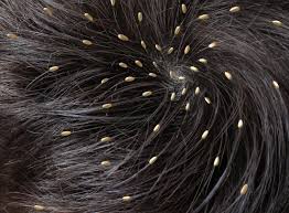 Head Lice Causes Symptoms And Treatments Head Louse Getting Rid Of Nits Lice Nits