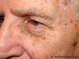 A blackhead is also called an open comedo (single for comedone), and it is a clogged pore in the skin that is open to the air. Favre Racouchot Syndrome American Osteopathic College Of Dermatology Aocd