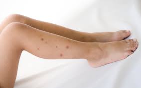Bug Bites That Look Like Mosquito Bites But Hurt How To Tell Bed Bug Bites Apart From Mosquito Bites Ecoraider Highly Efficacious Bio Insecticides For Bed Bugs Mosquitoes Ants And Roaches