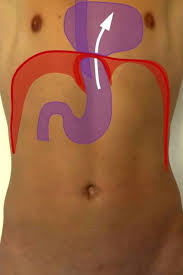 Reflux Op Und Zwerchfellbruch Op In Nurnberg Klinik Hallerwiese De