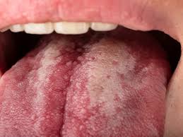Image result for cancer of tongue