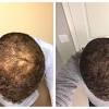 Here are 22 things you can try to stop hair loss now and prevent more hair loss in the future. 1