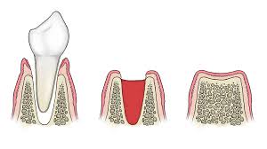 Consult with the treating surgeon. 9 Important Facts About Wisdom Teeth And Tooth Removal Webdento