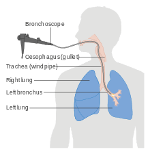 To place a stent (a tiny tube) to open a collapsed airway due to pressure by a mass or tumor; Bronchoscopy Wikipedia