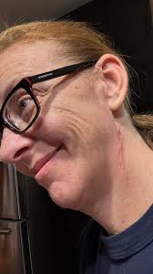 Curious what kind of underwear you can wear starting right after surgery.  please list type of surgical approach-anterior/posterior and M/F. i have  mine in 17 days. as a Scouter. i want to