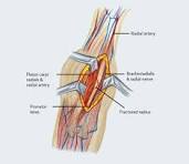 Forearm Fracture Fixation - Avanti