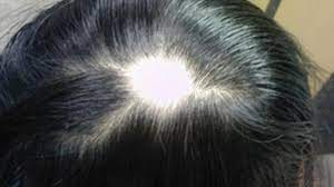 Tinea corporis ringworm on other parts of the body, such as the arms or legs. What Is Ringworm What Are Ringworm Symptoms And Treatment Methods