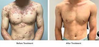 Image result for Atopic eczema atopic dermatitis