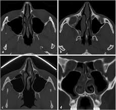 Haller's cells, also known as infraorbital ethmoid cells are located at the medial roof of the maxillary sinus in the inferior most portion of the lamina papyracea. Anterior Cranial Fossa Nasal Cavity And Paranasal Sinuses Radiology Key