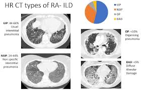 Image result for XRay Changes in Rheumatic Conditions