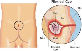 Image result for Pilonidal Cyst