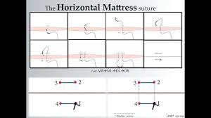 Maybe you would like to learn more about one of these? How To Create A Horizontal Mattress Suture By Surgicalmaster Youtube
