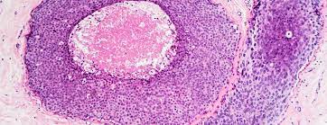 What causes kidney cancer (renal cell cancer)? Metastatic Brain Tumors Johns Hopkins Medicine