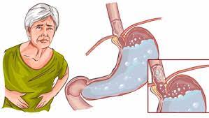 Ceai pentru stomac si intestine remedii naturiste ceai ceaiuri. Cum SÄƒ FoloseÈ™ti Corect Bicarbonatul De Sodiu Pentru Problemele Cu Stomacul