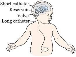 About Your Nonprogrammable Vp Shunt For Pediatric Patients Memorial Sloan Kettering Cancer Center