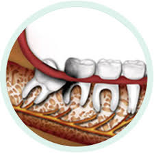The real cause of tooth decay (and how to stop it naturally). Q M Wisdom Tooth Wisdom Tooth Symptoms How To Remove Wisdom Tooth Before Wisdom Tooth Surgery