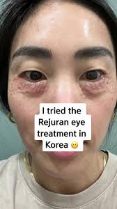 Dark circles 😩 #rejurani #rejuranhealer #rejuran #koreanskincare