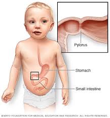 Larger polyps may cause internal bleeding or abdominal pain. Pyloric Stenosis Symptoms And Causes Mayo Clinic