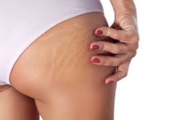Does Spray Tan Cover Stretch Marks Good Looking Tan