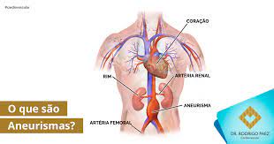 A aorta é a artéria principal que fornece sangue ao coração e a todas as outras um aneurisma que ocorre na área abdominal (do estômago) é chamado de aneurisma da aorta abdominal. O Que Sao Aneurismas Dr Rodrigo Paez Cardiovascular