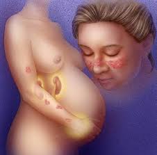 NHỮNG CÂU HỎI MẸ BẦU LUPUS