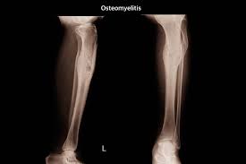 Knocheninfektion Osteomyelitis Ursachen Symptome Therapie
